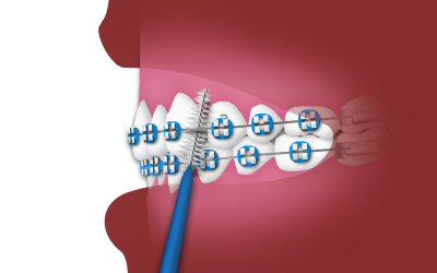 interdental