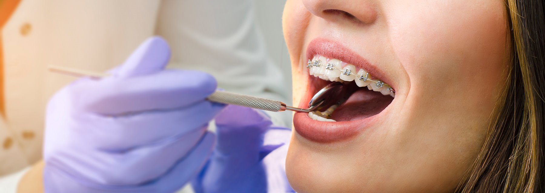 Adult Orthodontic Treatment in,Oregon