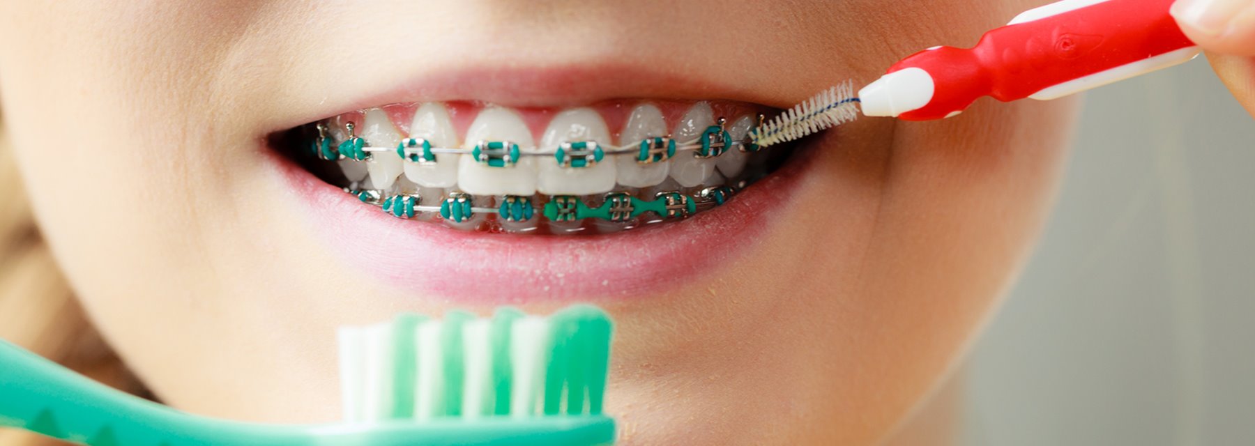 Orthodontic Oral Hygiene Tips in,Oregon